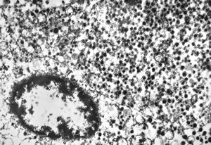 F, 79y. | paraganglioma … intestinal serosa F, 79y. | paraganglioma … intestinal serosa